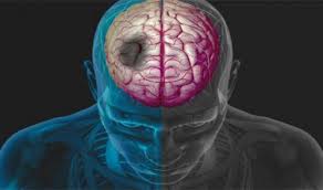 кава від інсульту